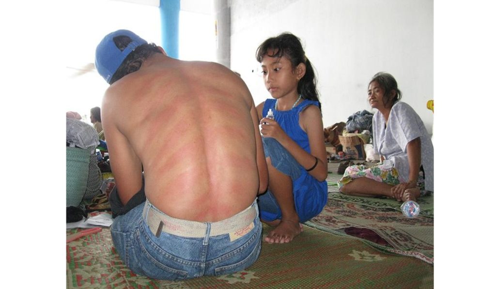 Foto  Kerokan Bocah Pengungsi untuk Sang Ayah
