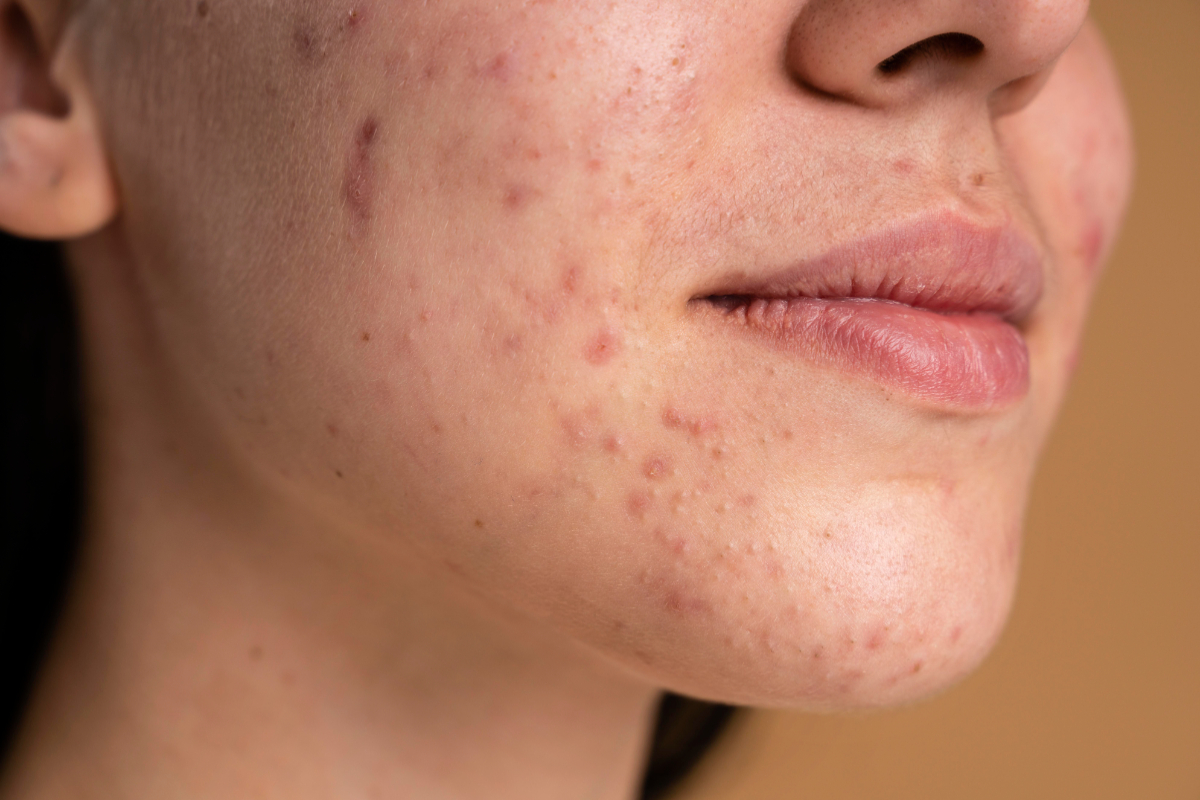 16 Tips Mengatasi Hitam Bekas Jerawat